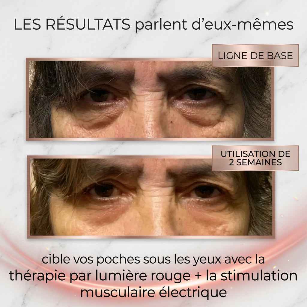 Lumière rouge et dispositif EMS pour réduire les poches sous les yeux avec RevitalEyes® UrbanHeight, vue d'ensemble du produit.