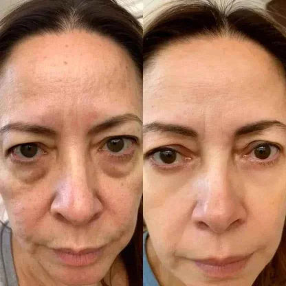 Dispositif RevitalEyes® UrbanHeight pour les poches sous les yeux, lumière rouge et EMS, traitement 2-en-1 pour le visage.